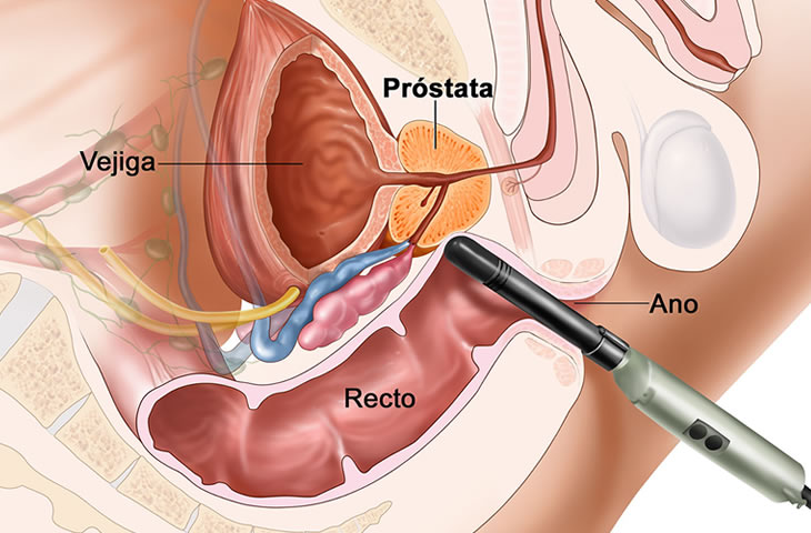 Tratamiento para Próstata